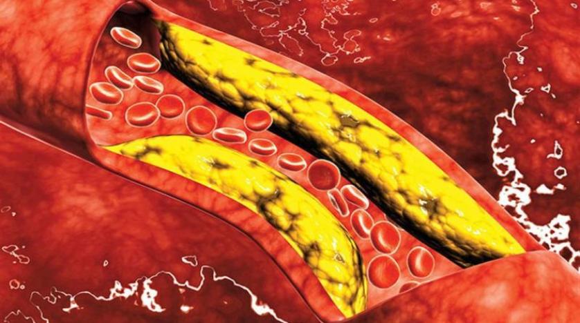 5 علامات تدل على ارتفاع نسبة الكوليسترول في الدم